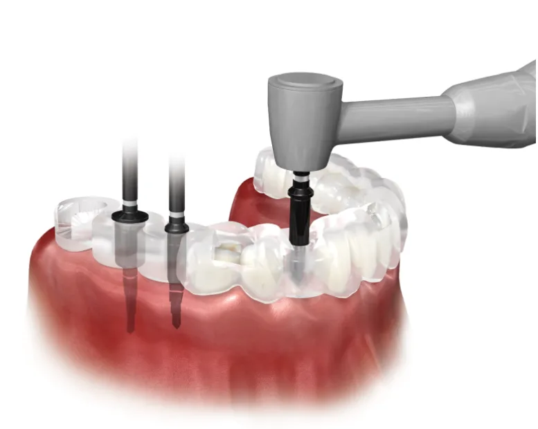 네비게이션 임플란트