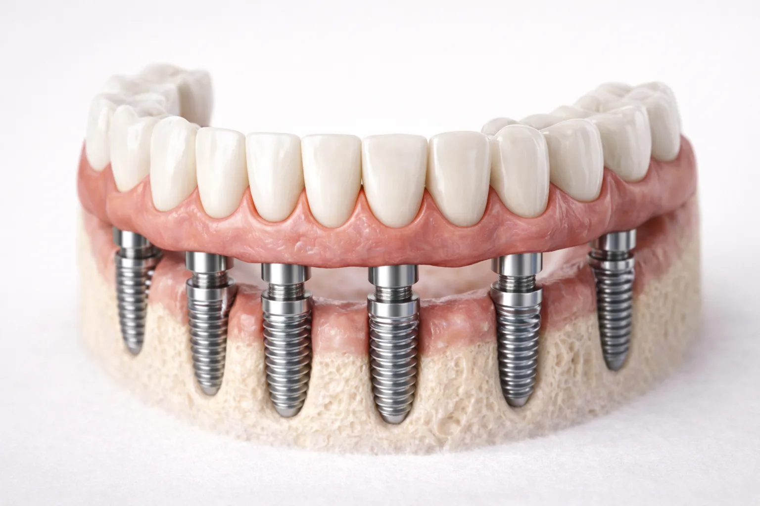 풀아치 임플란트