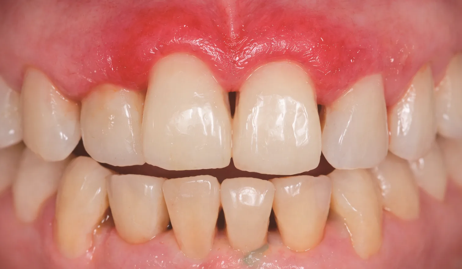 잇몸이 붓고 욱신거림