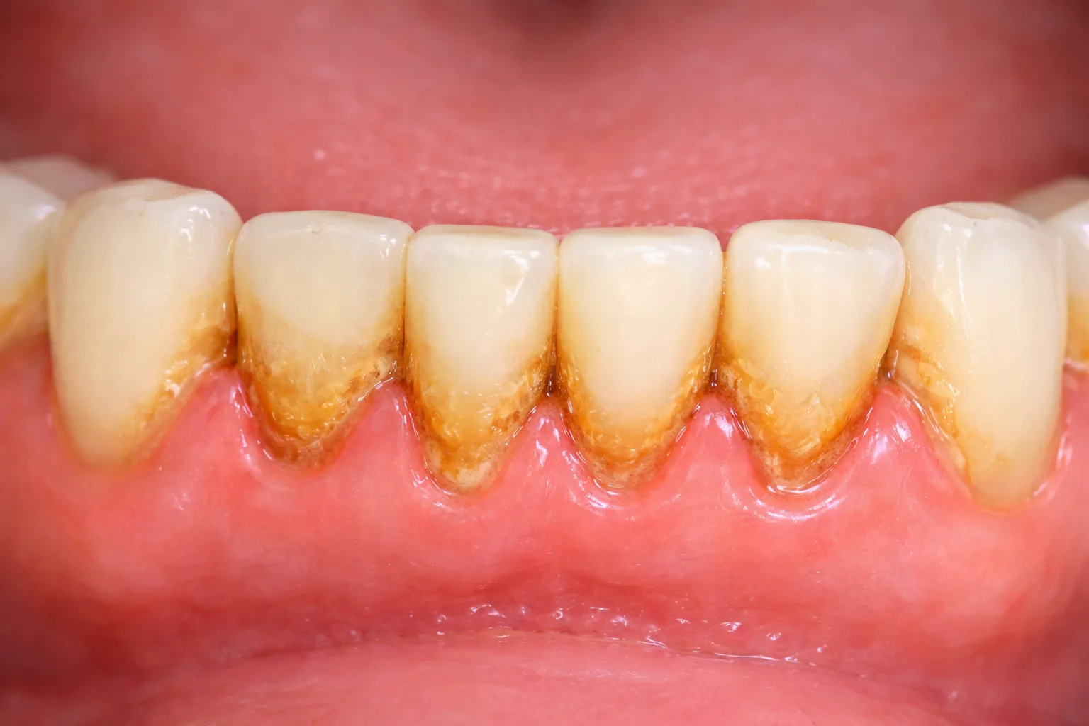 이가 흔들리는 느낌