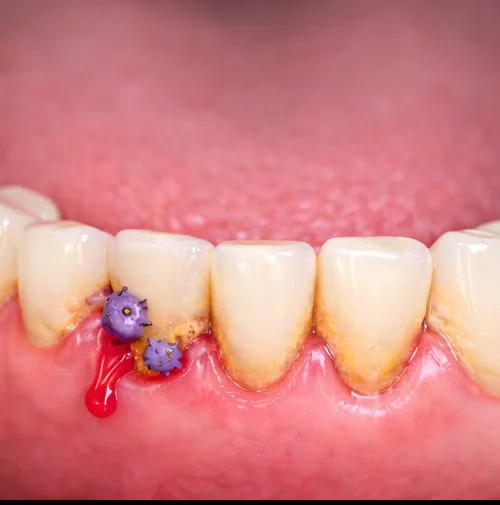 치석/치태 누적