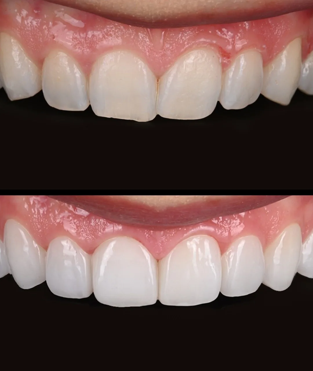 라미네이트 적용 사례 1