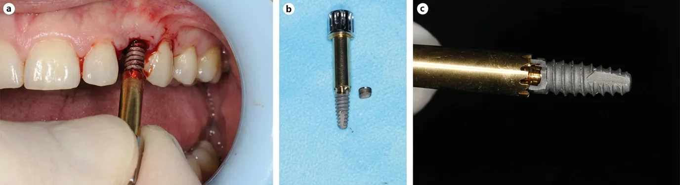 ② 기존 임플란트 제거