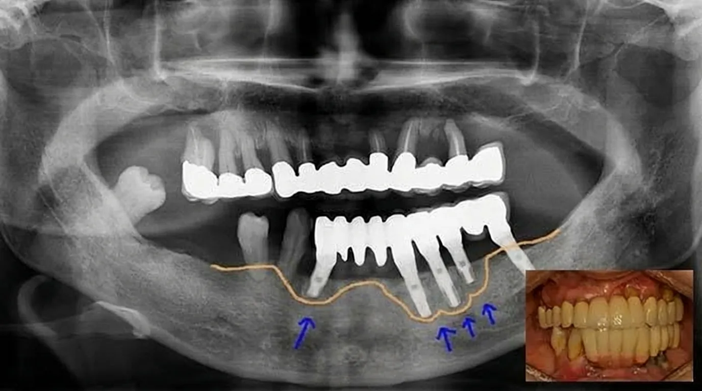 ① 정밀 진단 (CT + 구강 스캔)