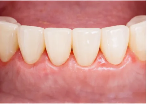 잇몸 건강 단계 이미지 1