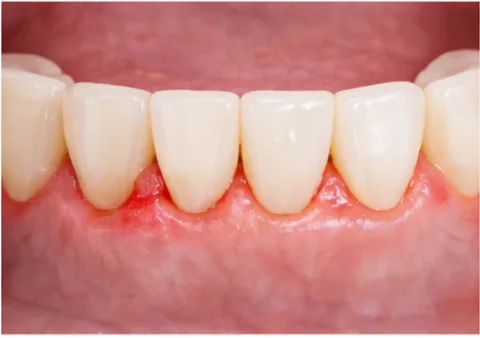 잇몸 건강 단계 이미지 2